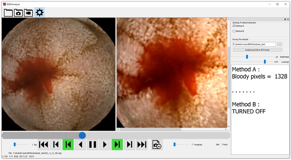 Automatic blood detection in capsule endoscopy video